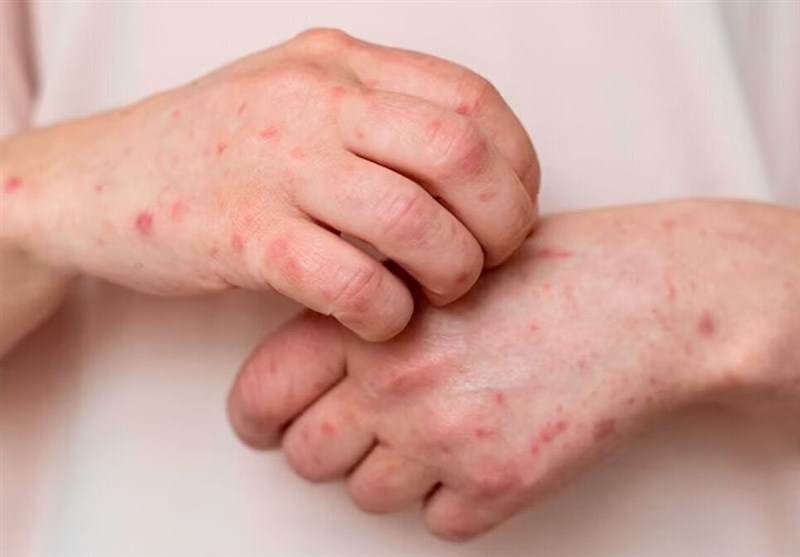 هوای پاییزی عامل افزایش ابتلا به آبلهمرغان