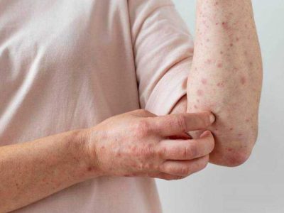 نادیده گرفتن آبله‌مرغان در بزرگسالان اشتباهی پرهزینه