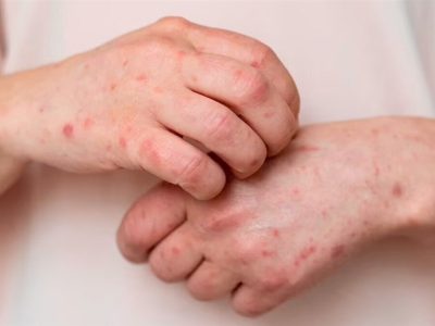 هوای پاییزی عامل افزایش ابتلا به آبله‌مرغان